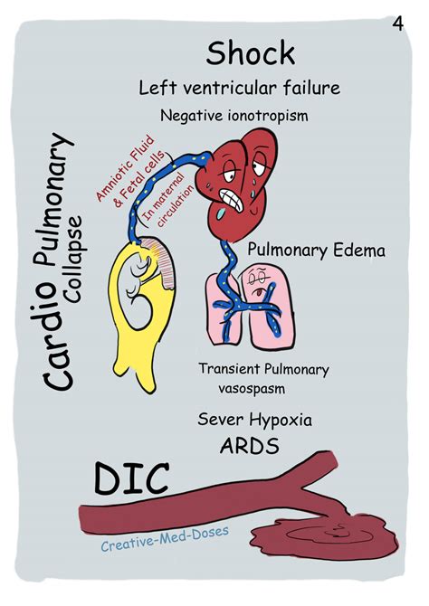 Amniotic Fluid Embolism - Creative Med Doses