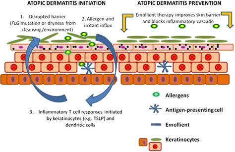 Emollient enhancement of the skin barrier from birth offers effective atopic dermatitis ...