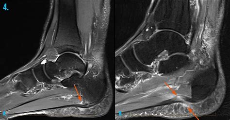MRI Scan for Ankle Injury Melbourne - Melbourne Radiology