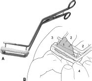 Left atrial appendage clip occlusion: Early clinical results - The Journal of Thoracic and ...