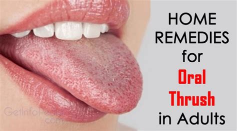 Home Remedies for Oral Thrush in Adults - Get Complete Information