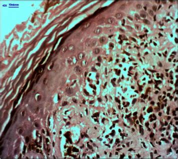 Histology of lichen planus pigmentosus. | Download Scientific Diagram