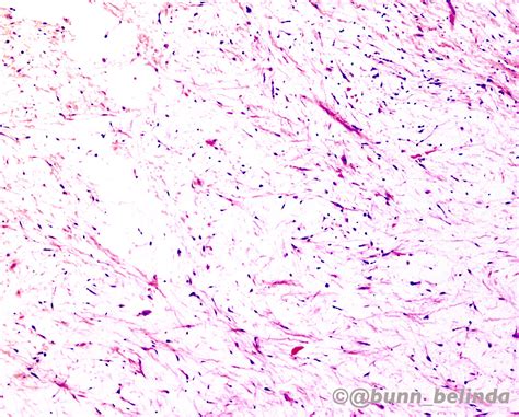 Odontogenic Myxoma Histology