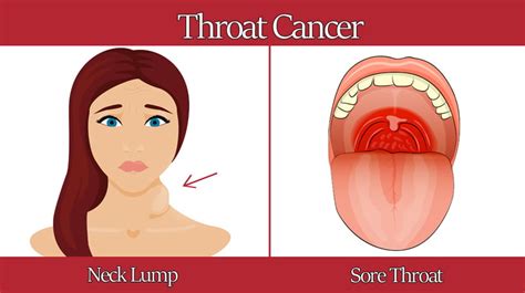 Can A Sore Throat Be A Sign Of Cancer - CancerWalls