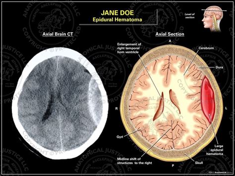 Epidural Hematoma