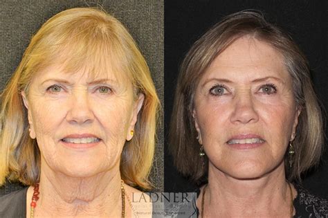 Facelift / Neck Lift Before and After Photo Gallery | Denver, CO ...