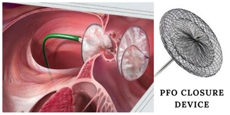 Global PFO Closure Device Market Poised to Take Off by 2023