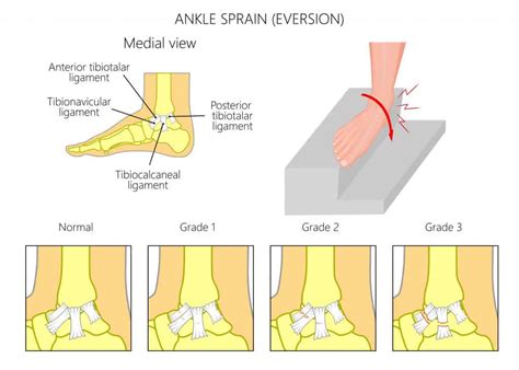 Deltoid Ligament Sprain | How to Treat a Sprain of the Deltoid Ligament