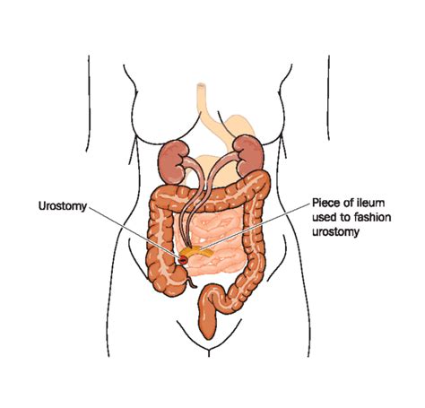 Urostomy Information l United Ostomy Associations of America