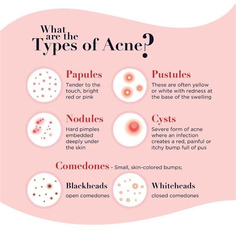 Nodular Acne Is Difficult to Treat—Here’s Why | Skin advice, Skin facts ...