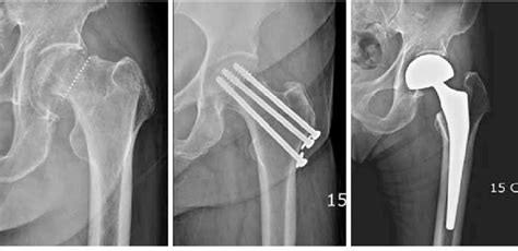 Femur Bone Fracture Surgery