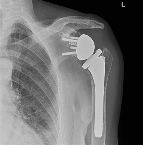 Reverse Shoulder Arthroplasty - StatPearls - NCBI Bookshelf