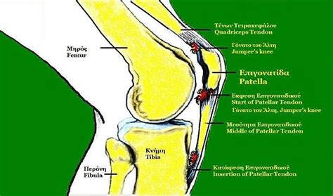 Patellar Tendinitis