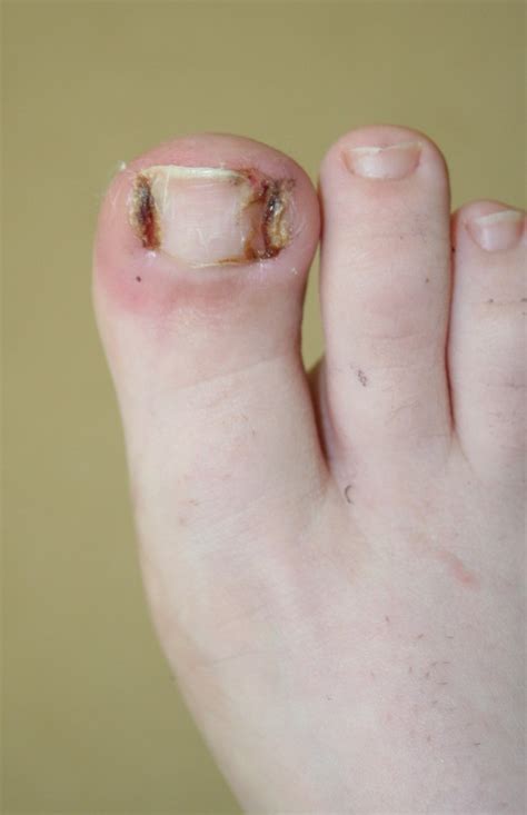 Ingrown Toenail Surgery - Buderim Podiatry | Sunshine Coast podiatrist ...