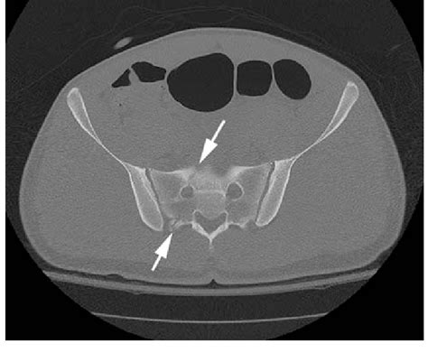 A CT scan shows a right sacral fracture, delineated by arrows. | Download Scientific Diagram