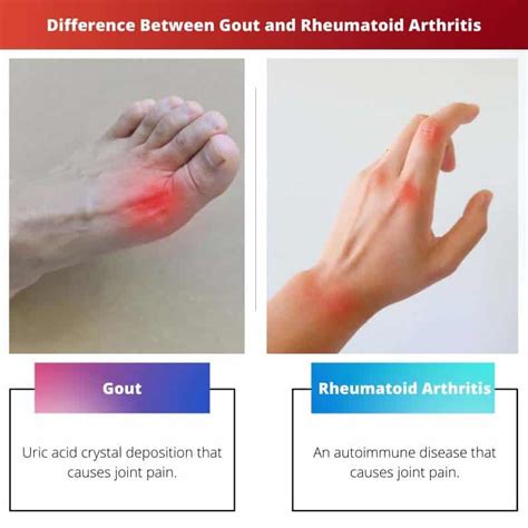 Gout vs Rheumatoid Arthritis: Difference and Comparison