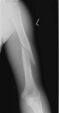 Left Humerus Fracture