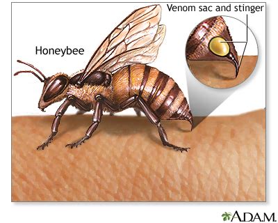 Insect stings and allergy: MedlinePlus Medical Encyclopedia Image