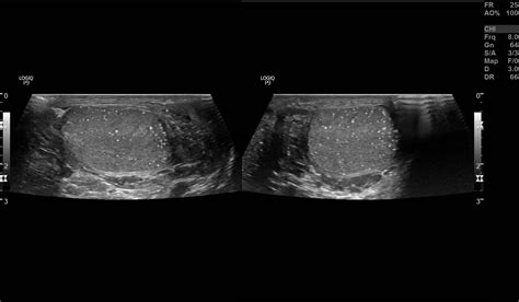 Testicular microlithiasis | Image | Radiopaedia.org