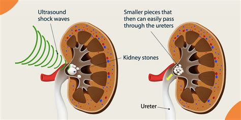 Extracorporeal Shock Wave Lithotripsy (ESWL): Purpose, Procedure, and ...