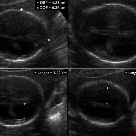 Obstetric ultrasonography showing the fetal cephalic pole with enlarged... | Download Scientific ...