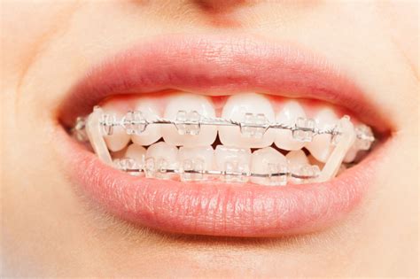 What Are Orthodontic Elastics (Rubber Bands) And How Do They Work