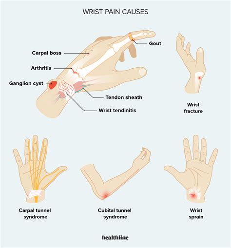 Ulnar Wrist Pain Causes