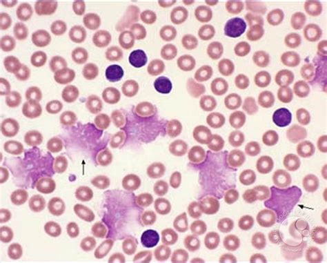 Chronic Lymphocytic Leukemia: Thrombocytopenia - 2.