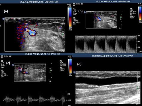 Dialysis Fistula Ultrasound