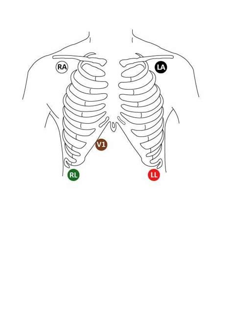 Holter Monitor 5 Lead Placement Diagram - General Wiring Diagram