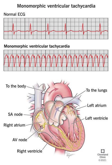 Monomorphic Ventricular Tachycardia (MVT): Causes and Treatment