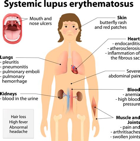 Systemic Lupus Erythematosus Treatment | Lupus Treatment | Lupus