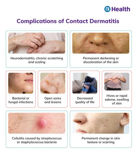 What causes contact dermatitis and how to treat it?
