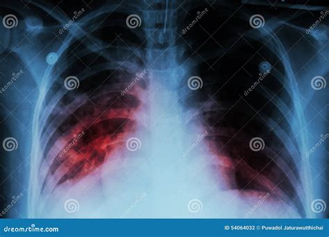 Pulmonary Tuberculosis ( TB ) : Chest X-ray Show Alveolar Infiltration At Both Lung Due To ...