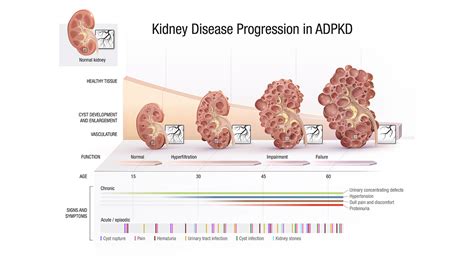 Medical Illustration: Kidney Disease Progression in ADPKD | Medical Animation | Scientific ...