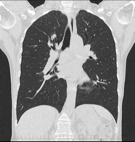 Chest CT Scan - Melbourne Radiology