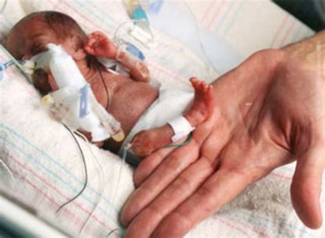 World's Smallest Baby Was Born - a True Miracle of God!