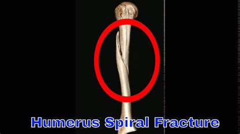 Splinting Humerus Fracture