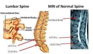 Spinal Fusion Complications Years Later - Long-term Effects of Spinal Fusion