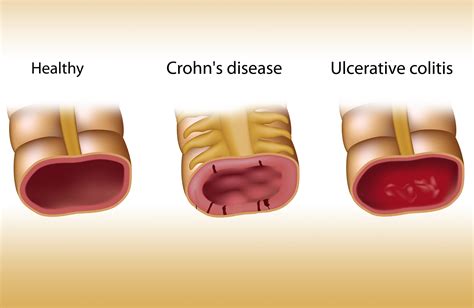 Inflammatory bowel disease and cannabis - a field report