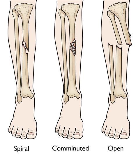 Tibial shaft fracture causes, types, symptoms, diagnosis, treatment & prognosis