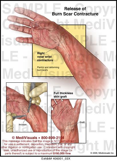 Release of Burn Scar Contracture - 406001_03X