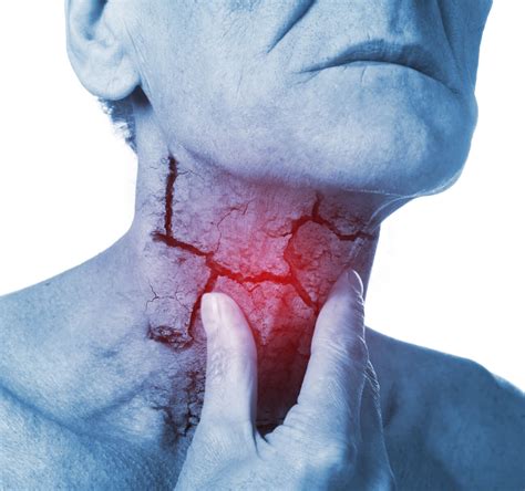 Stage 4 Throat Cancer | sjahs - St. Joseph Area Health Services