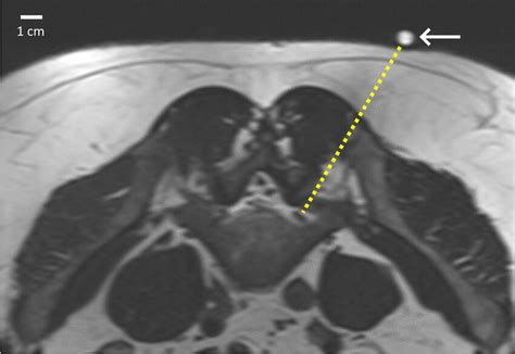 Axial T2-weighted MRI image of 43-year-old man with suspected left L5... | Download Scientific ...