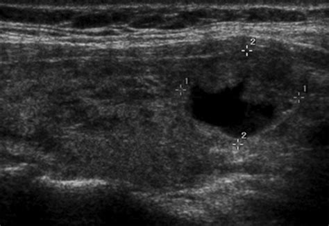 Sonographic Appearance of Thyroid Cancer in Patients With Hashimoto ...