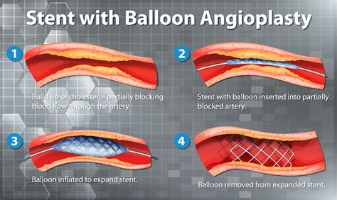 Free Vector | Diagram showing stent with balloon angioplasty in human