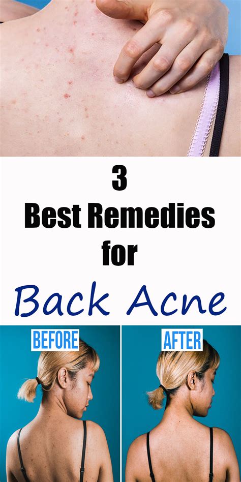 3 Best Remedies For Back Acne | Back acne remedies, Skin detox acne ...