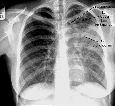 Lifting the veil: a case of lobar atelectasis -- Salati et al. 2010 -- BMJ Case Reports