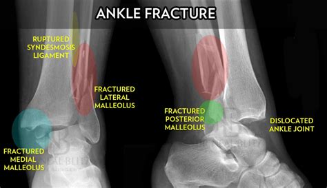 Tibia And Fibula Ankle Fracture