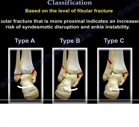 Danis Weber Classification of Ankle fractures — OrthopaedicPrinciples.com